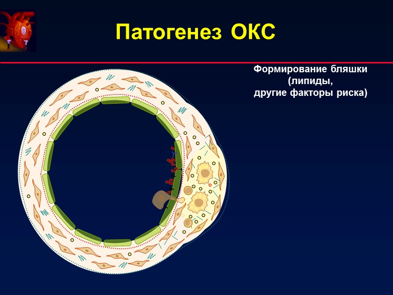 Патогенез ОКС Формирование бляшки (липиды, другие факторы риска) Патогенез ОКС Формирование бляшки (липиды, другие факторы риска)